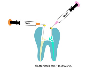 Root Canal Irrigation With EDTA And Sodium Hypochlorite