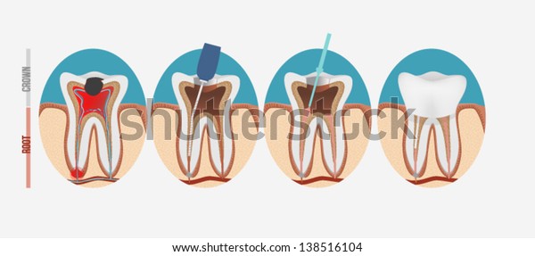 Root canal\
process