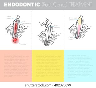 Root canal treatment. Dental infographic.. All objects are conveniently grouped  and are easily editable.