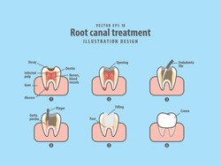 Root Canal Treatment Illustration Vector On Blue Background. Dental Concept.