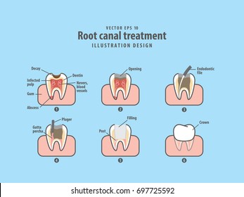 Root canal treatment illustration vector on blue background. Dental concept.