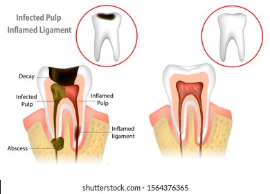 Root Canal Treatment. Infected Pulp and Inflamed Pulp. Tooth structure. Vector illustration 