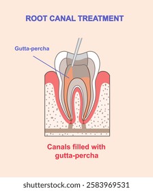 Root canal treatment infographics. Canals filled with gutta percha. Dentistry and stomatology. Healthcare and medicine. Flat vector illustration isolated on beige background