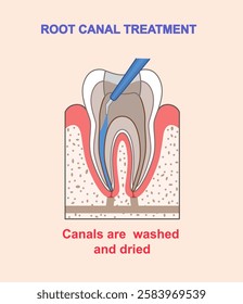 Root canal treatment infographics. Canals washed and dried. Dentistry and stomatology. Healthcare and medicine. Oral hygiene. Flat vector illustration isolated on beige background