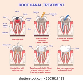 Root canal treatment. Medical infographic or diagram with stages of dental treatment. Diagnostics and filling of teeth damaged by caries. Dentistry and healthcare. Flat vector illustration