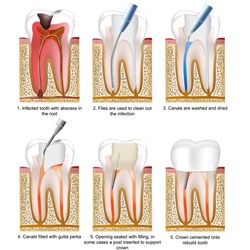 Root Canal Treatment Medical Vector Illustration Isolated On White Background With Description Eps 10