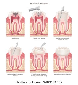 Root canal treatment. Tooth canal rooth filling endodontic procedure, roots bacteria infection dental caries treatment, maxillofacial gum anatomy diagram swanky vector illustration