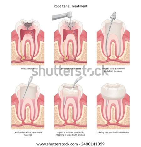 Root canal treatment. Tooth canal rooth filling endodontic procedure, roots bacteria infection dental caries treatment, maxillofacial gum anatomy diagram swanky vector illustration