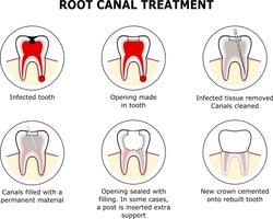 ROOT CANAL TREATMENT Vector Illustration
