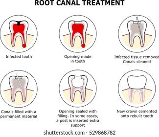 ROOT CANAL TREATMENT vector illustration