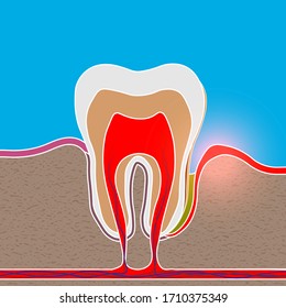 root inflammation, Gum disease, pus in the gum pocket, plaque and dental calculus. Periodontitis, Periodontitis, gingivitis