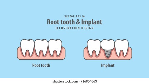 Root tooth & Implant illustration vector on blue background. Dental concept.