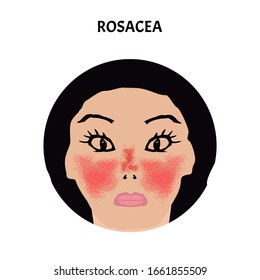 Rosacea. Mes de Concienciación de Rosacea. Infografía. Ilustración vectorial en fondo aislado.