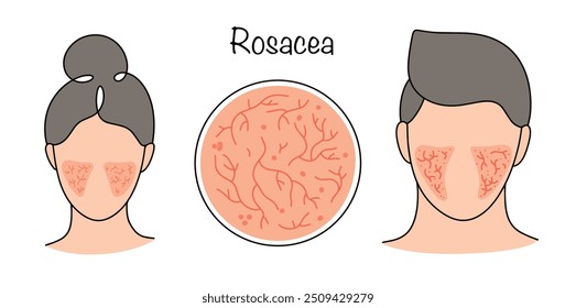 Rosácea. Patologia crônica não infecciosa da pele da face e do decote. Pessoas com uma doença nas bochechas. Ilustração de vetor de cores em um plano de fundo branco.