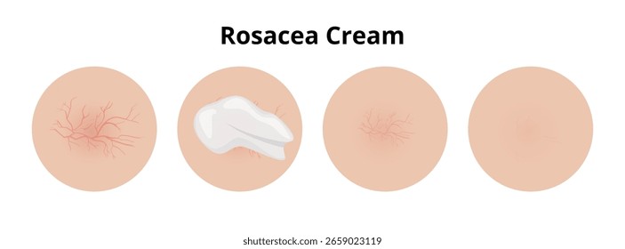 La crema de rosácea reduce eficazmente el enrojecimiento y los vasos sanguíneos visibles, ilustrando las etapas del tratamiento del cuidado de la piel, antes de la aplicación, durante el uso y después de lograr una mejora notable