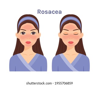 Rosacea. Isolated Beautiful Brunette woman. Cute face. Skin disease.Treatment.Woman with open eyes and closed. White background. Color Flat cartoon illustration.Poster.Vector stock illustration.