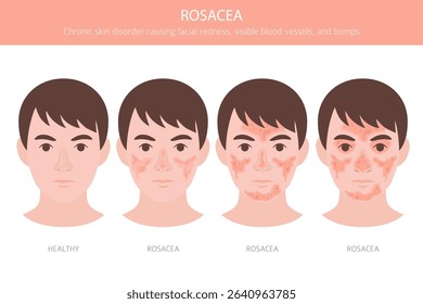 Rosacea. Skin diseases. Medical infographic design. Vector illustration