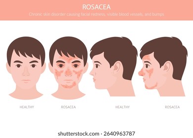 Rosacea. Skin diseases. Medical infographic design. Vector illustration