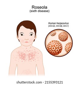 
Roseola. Signs and symptoms of ill. child with rash of sixth disease. infectious disease. Close-up of human herpes viruses. Vector illustration