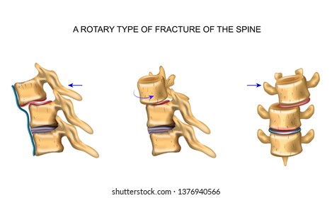 Rotational Type Of Vertebral Fracture