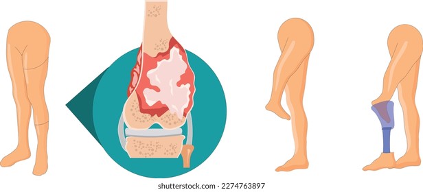 Rotationplasty surgery for bone tumor 