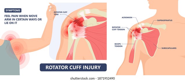 Rotator Cuff Disease sport pain torn tear arm treat frozen range of motion joint Chronic injuries heavy lifting sprain slap bicep problem degenerative bone tennis stiffness spur Physical therapy