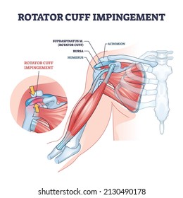 Rotator Cuff Impingement And Anatomical Shoulder Muscle Outline Diagram. Labeled Educational Muscular And Skeletal Description With Injury Example Vector Illustration. Supraspinatus Body Part Location