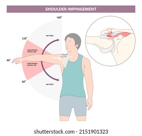 Rotator cuff SLAP tear torn pain injury tendon muscle joint X-ray range of motion space arm arc spur bone bursa sport overuse biceps tendinopathy labral tears rehab bankart lesion dislocated glenoid