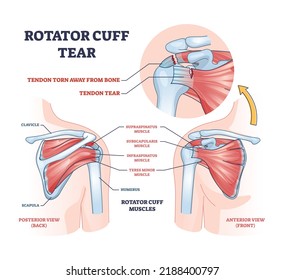 Rotator Cuff Tear As Shoulder Muscle Trauma Or Arm Injury Outline Diagram. Labeled Educational Upper Body Anatomy With Medical Tendon Torn Away From Bone Vector Illustration. Painful Joint Condition