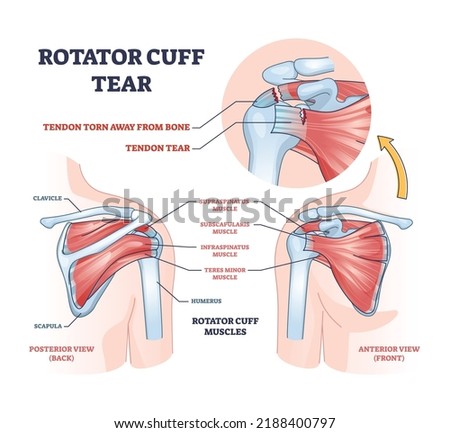 Rotator cuff tear as shoulder muscle trauma or arm injury outline diagram. Labeled educational upper body anatomy with medical tendon torn away from bone vector illustration. Painful joint condition Imagine de stoc © 