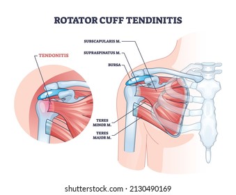 Rotator Cuff Tendinitis As Shoulder Muscular Inflammation Outline Diagram. Labeled Educational Anatomical Structure And Medical Description With Body Muscle Injury And Pain Cause Vector Illustration.