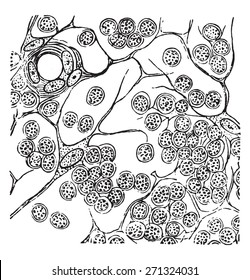 Round cell sarcoma of a lymphatic gland, vintage engraved illustration. 