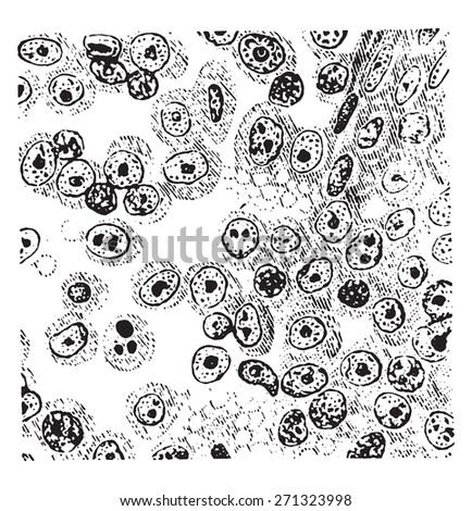 Round cell sarcoma, vintage engraved illustration. 