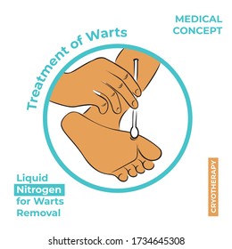 Round icon about the treatment of warts. Burning a wart with liquid nitrogen. A hand holds a stick with nitrogen and burning a wart on his leg.