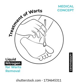 Round icon about the treatment of warts. Burning a wart with liquid nitrogen. A hand holds a stick with nitrogen and burning a wart on his leg.