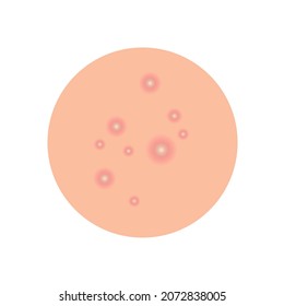 A round piece of skin with pimples. Inflammatory acne on the body. Vector illustration, flat minimal cartoon design isolated on white background, eps 10.