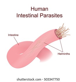 roundworm or hookworm in the small intestine, a medical poster location of ascarids in the human body