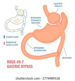 Roux-en-y Gastric Bypass. Bariatric Surgery Weight Loss Procedure. Stomach Reduction Anatomical Diagram Infographic. Health Care  Medical Concept. Vector Illustration.