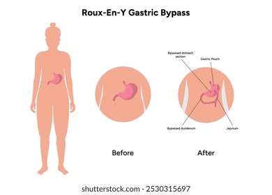 Roux-en-y gastric bypass. Gastrectomy medical infographic