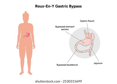 Roux-en-y gastric bypass. Gastrectomy medical infographic