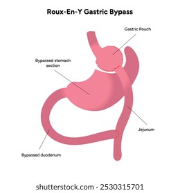 Roux-en-y gastric bypass. Gastrectomy medical infographic