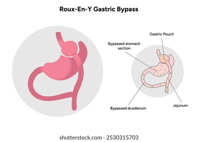 Roux-en-y gastric bypass. Gastrectomy medical infographic