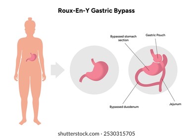 Roux-en-y gastric bypass. Gastrectomy medical infographic