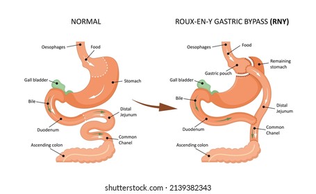 Roux-en-y gastric bypass (RNY).  Showing a gastric pouch and gastrojejunal anastomosis.