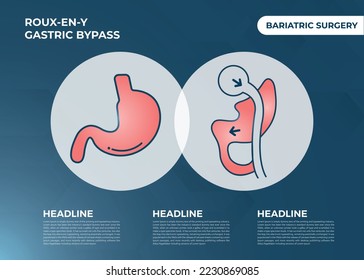 Roux-en-Y Gastric Bypass (RNY) Weight Loss Surgery vector illustration icon