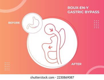 Roux-en-Y Magensonde (RNY) Weichteil Chirurgisches Vektorgrafik-Symbol