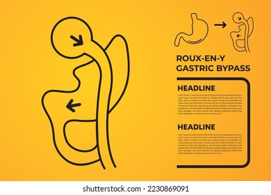 Roux-en-Y Gastric Bypass (RNY) Weight Loss Surgery vector illustration icon