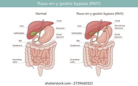 Roux-en-Y gastric bypass. Vector illustration