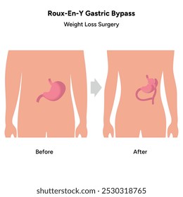 Roux-en-y gastric bypass, weight loss surgery. Gastroenterology medical disease