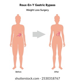 Roux-en-y gastric bypass, weight loss surgery. Gastroenterology medical disease